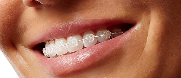 ceramic braces